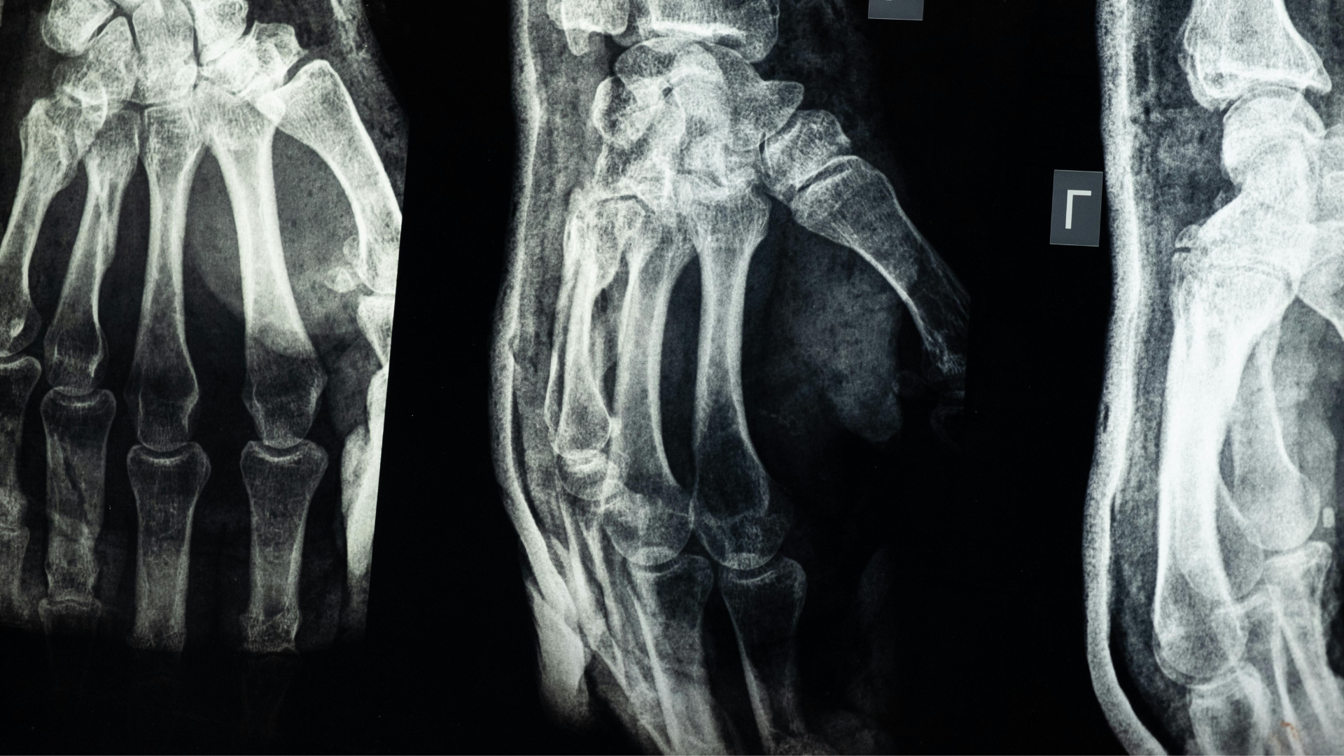 hand & finger fracture diagnosis boise